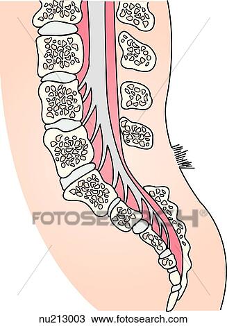 Drawing - Sagittal view of the spinal column and spinal cord in a case of spina bifida occulta.. Fotosearch