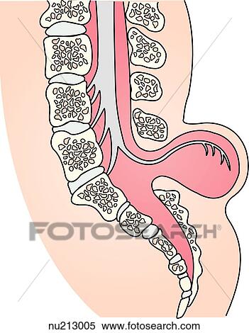 Stock Illustration - Sagittal view of the spinal column and spinal cord with a myelomeningocele.. Fotosearch