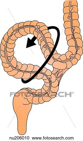 The unattached loop of bowel twists causing the bowel lumen to become obstructed. View Large Illustration Clipart - The unattached loop of bowel twists causing the bowel lumen to become obstructed.. Fotosearch