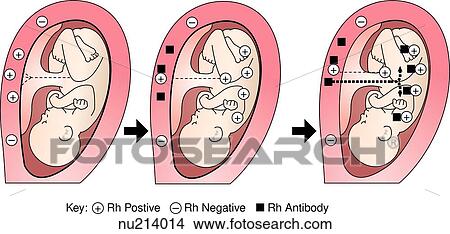 Stock Illustration - Three images illustrating maternal antibody formation preceding sensitization of the fetus to Rh antigen.. Fotosearch