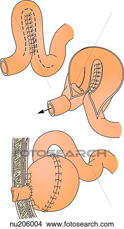 Three part illustration showing section of intestine undergoing procedure for creating a continent iliostomy. Top: bowel segment anastomosed. Center: pouch is formed. Bottom: pouch shown in place with stoma. View Large Illustration Stock Illustration - Three part illustration showing section of intestine undergoing procedure for creating a continent iliostomy. Top: bowel segment anastomosed. Center: pouch is formed. Bottom: pouch shown in place with stoma.. Fotosearch
