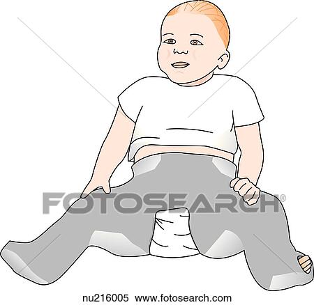 Stock Illustration - Toddler with a hip abduction cast for correcting subluxation of the hip.. Fotosearch