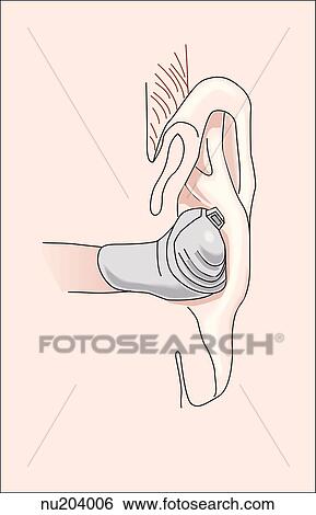 Transverse section of head at left ear showing hearing aid located in the ear canal. View Large Illustration Stock Illustration - Transverse section of head at left ear showing hearing aid located in the ear canal.. Fotosearch