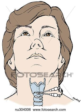 Stock Illustration - A cricothyroidotomy, or cricothyroid membrane puncture. Anterior view of head and neck, with needle inserted below thyroid cartilage and just above cricoid cartilage.. Fotosearch