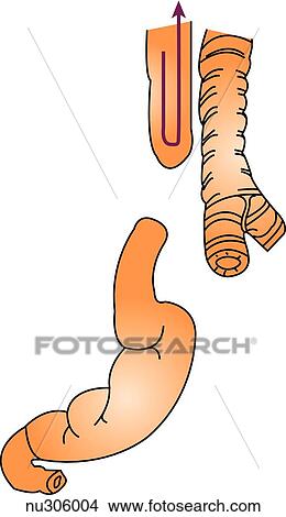 Stock Illustration - A form of esophageal atresia is shown in which both upper and lower segments of the esophagus end in a blind pouch. This occurs in 5% to 8% of infants with this defect. Arrows indicate the flow of food and air.. Fotosearch