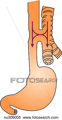 A form of esophageal atresia is shown in which both upper and lower segments of the esophagus communicate wirth the trachea. This occurs in 2% to 3% of infants with this defect. Arrows indicate the flow of food and air. View Large Illustration Stock Illustration - A form of esophageal atresia is shown in which both upper and lower segments of the esophagus communicate wirth the trachea. This occurs in 2% to 3% of infants with this defect. Arrows indicate the flow of food and air.. Fotosearch