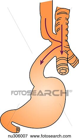 Stock Illustration - A form of esophageal atresia is shown in which a fistula connects both upper and lowers segments of the esophagus. Arrows indicate the flow of food and air.. Fotosearch