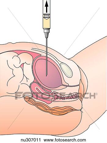 A suprapubic aspiration. The full bladder is easily accessible by an abdominal puncture. View Large Illustration Clip Art - A suprapubic aspiration. The full bladder is easily accessible by an abdominal puncture.. Fotosearch