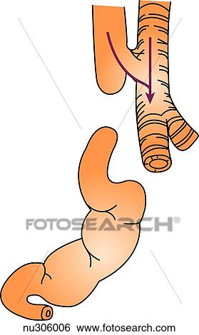 A very rare form of esophageal atresia is shown in which both upper segments of the esophagus ends in a blind pouch and communicate by fistula with the trachea. Arrows indicate the flow of food and air. View Large Illustration Stock Illustration - A very rare form of esophageal atresia is shown in which both upper segments of the esophagus ends in a blind pouch and communicate by fistula with the trachea. Arrows indicate the flow of food and air.. Fotosearch
