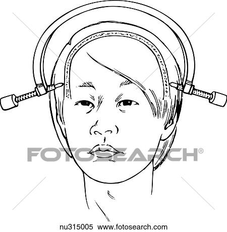 Stock Illustration - Anterior view of male head with Gardner-Wills traction tongs in place. Skull is illustrated to show placement of pins.. Fotosearch
