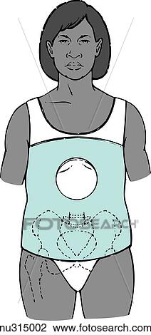 Drawing - Anterior view of woman from head to thigh encased in a body cast. Pelvic bones superimposed on image to show possible pressure area.. Fotosearch
