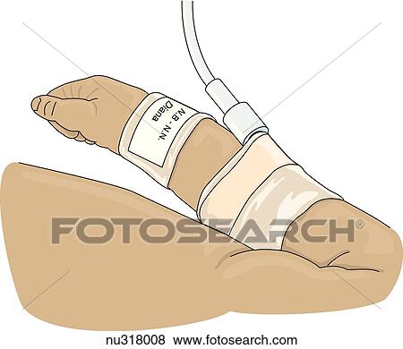 Arm of infant shown wearing name tag on wrist with IV in place. View Large Illustration Stock Illustration - Arm of infant shown wearing name tag on wrist with IV in place. . Fotosearch