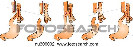 Five variations of esophageal atresia are shown. The most common form is shown on the left where the esophagus ends in a blind pouch. Arrows indicate the flow of food and air. View Large Illustration Drawing - Five variations of esophageal atresia are shown. The most common form is shown on the left where the esophagus ends in a blind pouch. Arrows indicate the flow of food and air.. Fotosearch