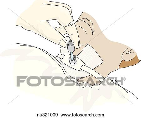 Stock Illustration - Gloved hand replaces inner cannula into outer cannula of a tracheostomy tube after cleaning.. Fotosearch