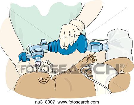 Stock Illustration - Hands of nurse shown facillitating breathing of prone infant with Ambu bag.. Fotosearch