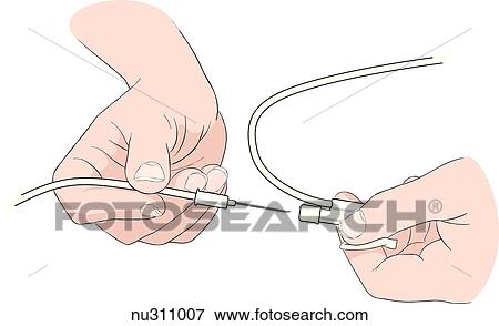 Stock Illustration - Hands shown inserting needle into secondary port of IV set.. Fotosearch