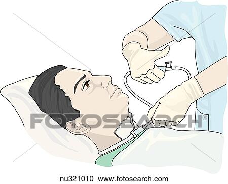 Illustrating showing nurse inserting the catheter with the suction off. View Large Illustration Clipart - Illustrating showing nurse inserting the catheter with the suction off.. Fotosearch