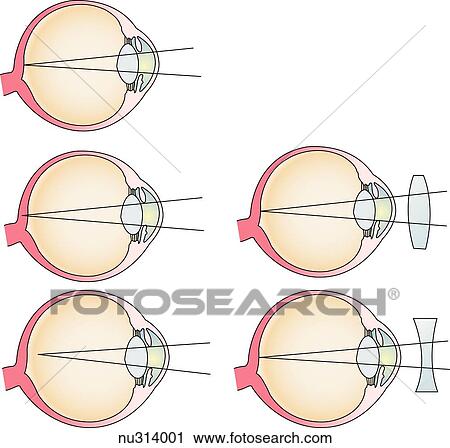 Illustration demonstrating how corrective lenses aid in seeing. (Top) normal vision. (Middle) convex lens for hyperopia (farsightedness), (bottom) concave lens for myopia (nearsightedness). View Large Illustration Clip Art - Illustration demonstrating how corrective lenses aid in seeing. (Top) normal vision. (Middle) convex lens for hyperopia (farsightedness), (bottom) concave lens for myopia (nearsightedness).. Fotosearch