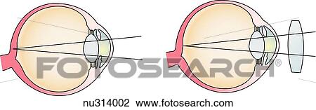 Illustration demonstrating how corrective lenses aid in seeing. Convex lens are used to correct hyperopia (farsightedness). View Large Illustration Drawing - Illustration demonstrating how corrective lenses aid in seeing. Convex lens are used to correct hyperopia (farsightedness).. Fotosearch