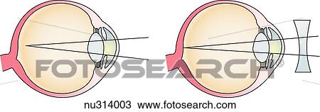 Drawing - Illustration demonstrating how corrective lenses aid in seeing. Concave lens are used to correct myopia (nearsightedness).. Fotosearch