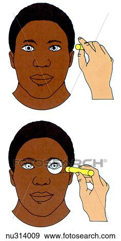 Illustration demonstrating pupillary reaction to light. A pen light is moved from the side of the patient's face (top) to in front of the eye (bottom). The pupil should constrict when the light is present. The dilation or constriction shown is exaggera View Large Illustration Stock Illustration - Illustration demonstrating pupillary reaction to light. A pen light is moved from the side of the patient's face (top) to in front of the eye (bottom). The pupil should constrict when the light is present. The dilation or constriction shown is exaggera. Fotosearch