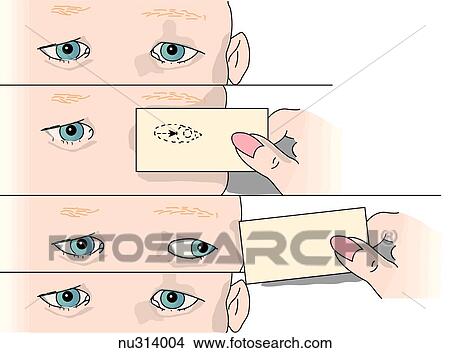 Stock Illustration - Illustration demonstrating technique for cover test to test for exophoria (misalignment). Child's eyes appear to be in good alignment. Left eye is then covered for 5 seconds. When card is removed, left eye moves back to alignment. This "drifting" indicat. Fotosearch