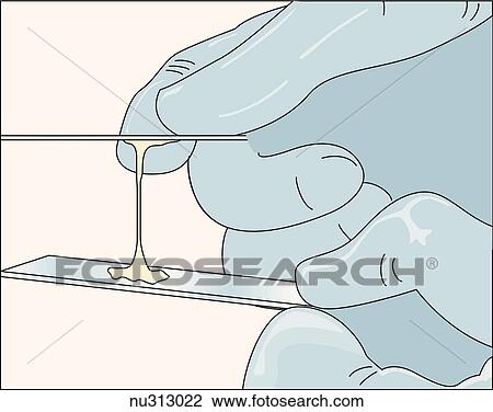 Illustration depicting a health care worker testing the spinnbarkeit (stretchability) of the cervical mucous. Spinbarkeit is the property of ervical mucous to stretch a distance of 23 to 15 cm before breaking indicating a heigh level of estrogen. View Large Illustration Drawing - Illustration depicting a health care worker testing the spinnbarkeit (stretchability) of the cervical mucous. Spinbarkeit is the property of ervical mucous to stretch a distance of 23 to 15 cm before breaking indicating a heigh level of estrogen.. Fotosearch