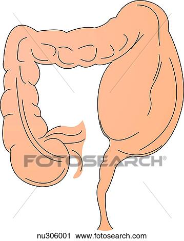 Illustration Of Aganglionic Megacolon Where Lower Portion Of Sigmoid Colon Just Above Rectum Appears Narrowed Portion Of Bowel Proximal To This Obstruction Is Markedly Distended Clip Art Nu Fotosearch