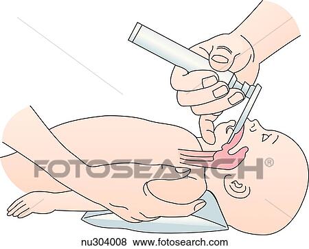 Stock Illustration - Illustration of insertion of blade of laryngoscope in infant. Head of infant is in neutral position with towel under shoulders. Pharynx and trachea are shown.. Fotosearch