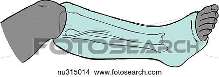 Stock Illustration - Illustration of right leg from knee to foot encased in a short leg cast. Lateral malleolus and peroneal nerve shown to indicate possible pressure areas.. Fotosearch