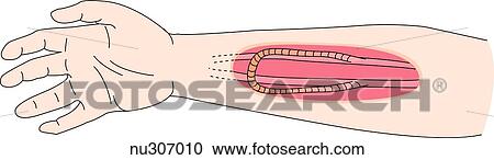 Clipart - Illustration of the medial side of the right arm with an internal arteriovenous graft used in hemodialysis. The artery and vein are anastomosed using a subcutaneous graft.. Fotosearch