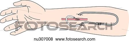 Stock Illustration - Illustration of the medial side of the right arm with an external arteriovenous shunt uses in hemodialysis.. Fotosearch