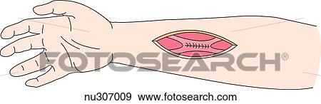 Stock Illustration - Illustration of the medial side of the right arm with an internal arteriovenous fistula used in hemodialysis.. Fotosearch