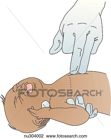 Illustration showing the cardiac resusitation technique in a newborn or infant by pressing two fingers on the midsternum. View Large Illustration Drawing - Illustration showing the cardiac resusitation technique in a newborn or infant by pressing two fingers on the midsternum.. Fotosearch