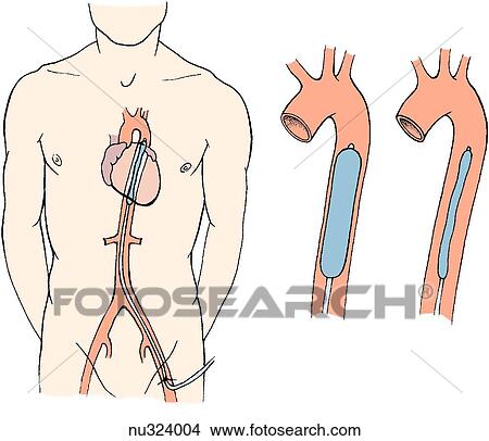 Image on left shows thorax with intra-aortic balloon catheter introduced via the femoral artery. Center image shows aorta with catheter inflated as in diastole. Image on right shows aorta with catheter deflated as in systole. View Large Illustration Stock Illustration - Image on left shows thorax with intra-aortic balloon catheter introduced via the femoral artery. Center image shows aorta with catheter inflated as in diastole. Image on right shows aorta with catheter deflated as in systole.. Fotosearch