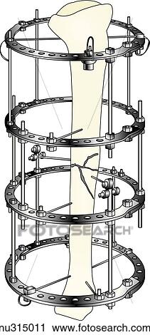 Clip Art - Image showing a Llizarov device in place to treat comminuted fracture.. Fotosearch