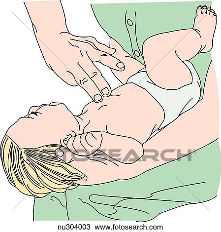 Drawing - Infant is held lying face up along the length of an adult thigh while a hand administers chest thrusts in the proper direction to relieve a complete foreign body airway obstruction.. Fotosearch