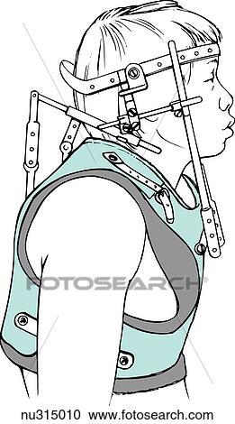 Clipart - Lateral view of adult male in Halo vest traction (a type of cervical traction).. Fotosearch