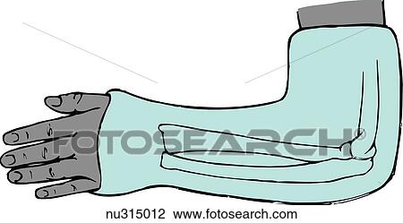 Left arm shown from biceps down in long arm cast. Radial styloid, ulnar styloid, and lateral epicondyle illustrated upon cast to show possible pressure area of cast. View Large Illustration Drawing - Left arm shown from biceps down in long arm cast. Radial styloid, ulnar styloid, and lateral epicondyle illustrated upon cast to show possible pressure area of cast.. Fotosearch