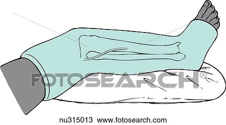 leg from thigh to foot encased in a long leg cast and propped on a pillow. Bones of lower leg and peroneal nerve shown to indicate possible pressure areas. View Large Illustration Drawing - leg from thigh to foot encased in a long leg cast and propped on a pillow. Bones of lower leg and peroneal nerve shown to indicate possible pressure areas.. Fotosearch