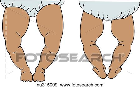 Stock Illustration of Legs of an infant with genu varum, bowleggedness ...