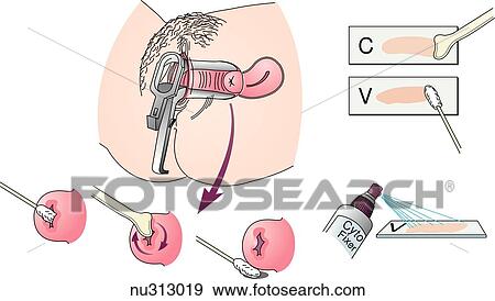 Obtaining a Pap smear; (bottom left) specimen taken from endocervix; (bottom middle) specimen taken from cervix; (bottom right) specimen taken from vaginal pool. View Large Illustration Stock Illustration - Obtaining a Pap smear; (bottom left) specimen taken from endocervix; (bottom middle) specimen taken from cervix; (bottom right) specimen taken from vaginal pool.. Fotosearch