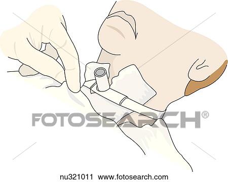 Clip Art -  patient's neck, from mouth down, with trachostomy tube in place.. Fotosearch