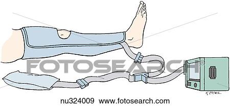 Stock Illustration - Right leg shown from hip to foot encased in pneumatic hose.. Fotosearch
