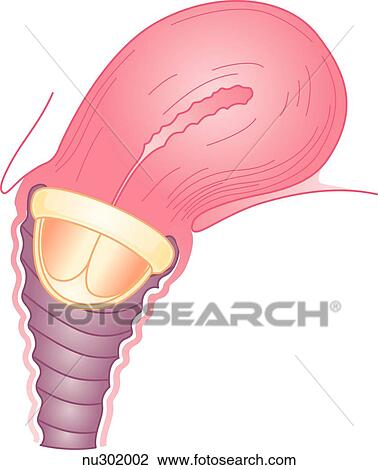 Sagittal section of uterus, cervix and upper portion of vagina of adult female. A cervical cap is in place fitted snugly over uterine cervix. View Large Illustration Drawing - Sagittal section of uterus, cervix and upper portion of vagina of adult female. A cervical cap is in place fitted snugly over uterine cervix.. Fotosearch