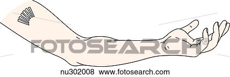 Stock Illustration - Sagittal view of extended arm from shoulder down to hand. Norplant implants are visible under skin on inside of upper arm in the area of the bicep muscle.. Fotosearch