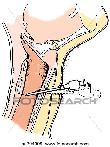 Sagittal view of neck region with needle inserted just above upper part of cricoid cartilage. View Large Illustration Stock Illustration - Sagittal view of neck region with needle inserted just above upper part of cricoid cartilage.. Fotosearch