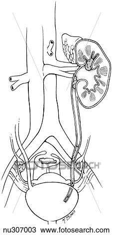 Drawing - Simple illustration of urinary system. Kidney and ureter are shown in cross-section to reveal calculi causing obstructions at various sites.. Fotosearch