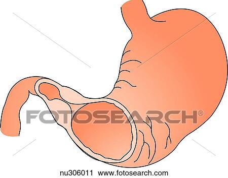 Clip Art -  stomach and upper portion of duodenum with anterior wall removed at junction to reveal a stenosed pyloric valve. . Fotosearch