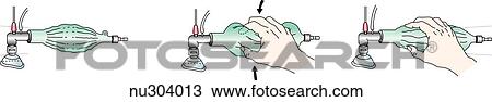 Drawing - Technique for using a low inflating anesthesia bag with compressed gas source for neonatal resuscitation.. Fotosearch